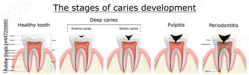 Stages of caries development. Dental disease: caries, pulpitis and periodontitis, realistic vector illustration photo