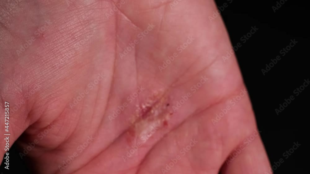 Close up view of cracked dry skin of palm. Woman shows her hand with psoriasis, eczema and tiny blisters. Chemical irritation, damaged skin, dermatological disease on female hands. Dark background, 4k Close up view of cracked dry skin of palm. Woman shows her hand with psoriasis, eczema and tiny blisters. Chemical irritation, damaged skin, dermatological disease on female hands. Dark background, 4k