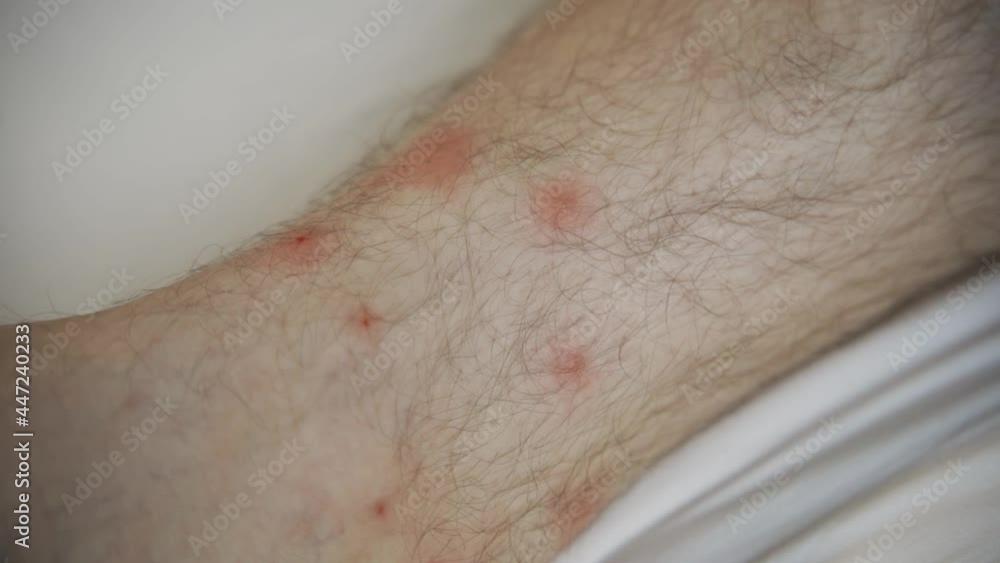 doctor treats a large healing wound from on lower leg with scars of adult male patient, redness, scarring of the skin, the concept of medical care, human tissue regeneration. doctor treats a large healing wound from on lower leg with scars of adult male patient, redness, scarring of the skin, the concept of medical care, human tissue regeneration.
