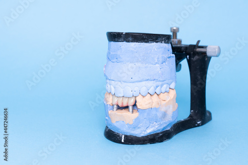 Veneers and crowns on gypsum dental artificial jaw on blue background. Upper and lower jaws plaster model with prepared teeth on diagnostic model. Concept of aesthetic dentistry. restoration of teeth