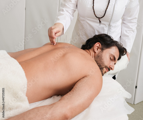 Treatment of back pain and tightness with acupuncture needles for a male patient, Traditional Chinese Medicine. Alternative medicine, reflexology photo