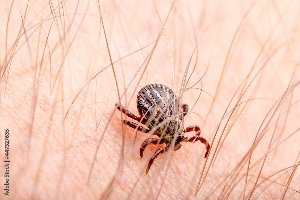 infectious-encephalitis-tick-insect-on-skin-encephalitis-virus-or-lyme