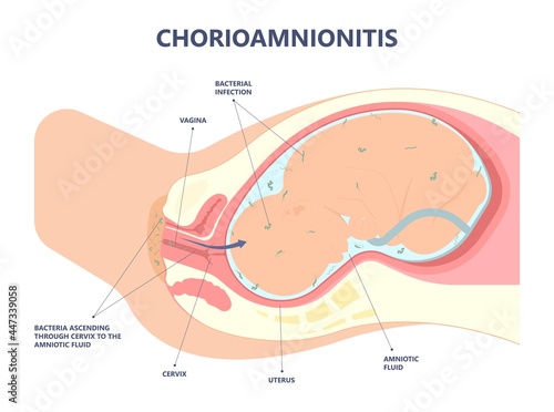 sepsis birth preterm atony baby intra bacteria women water breaks labor fetus fluid mother poly microbial disease urinary tract E. coli genital vagina uterus health Group B Strep amnion Fetal system