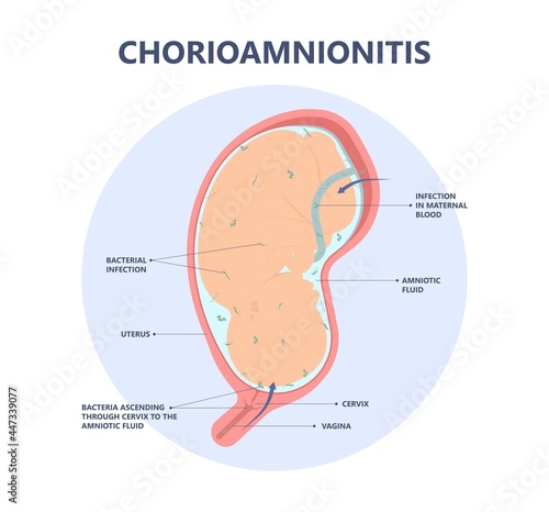 sepsis birth preterm atony baby intra bacteria women water breaks labor fetus fluid mother poly microbial disease urinary tract E. coli genital vagina uterus health Group B Strep amnion Fetal system