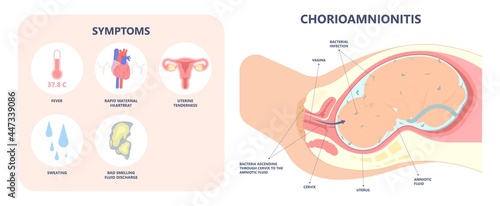 sepsis baby birth preterm labor fetus fluid atony intra bacteria women water breaks mother poly microbial disease urinary tract E. coli genital vagina uterus health Group B Strep amnion Fetal system
