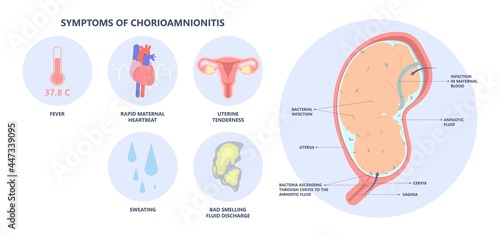 sepsis birth preterm atony baby intra bacteria women water breaks labor fetus fluid mother poly microbial disease urinary tract E. coli genital vagina uterus health Group B Strep amnion Fetal system