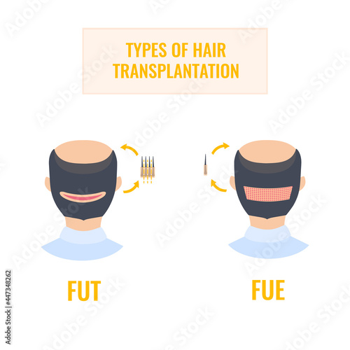 Hair transplantation infographics of man heads in rear view. FUT and FUE male alopecia treatment methods. Follicular unit extraction versus follicular unit transplantation. Medical vector illustration