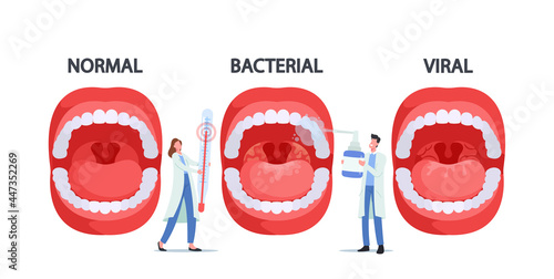 Doctors Characters with Thermometer and Spray for Throat Presenting Normal, Bacterial and Viral Pharyngitis Infection