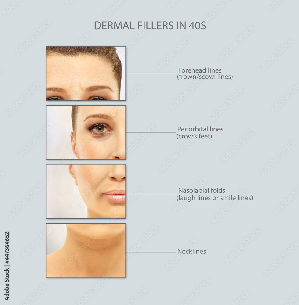 dermal filler treatments .Hyaluronic acid injections for specific areas