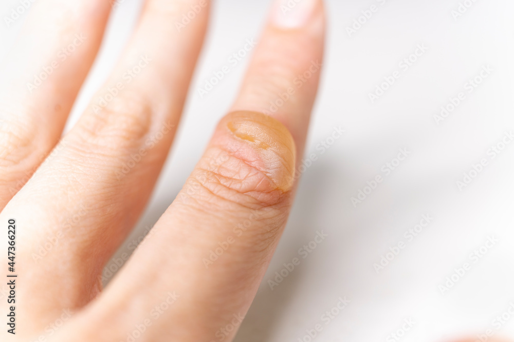 There is a blister on woman's hand from a burn. Burn of the finger. A