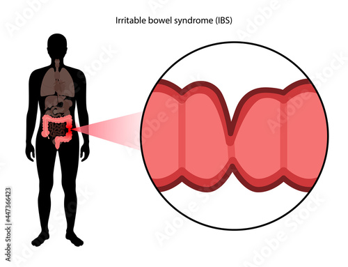 Irritable bowel syndrome