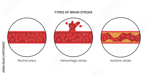 Brain stroke ishemic and hemorrhagic
