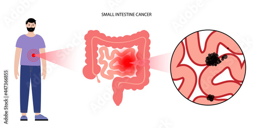 Small intestine cancer