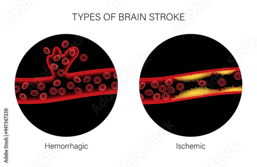 Brain stroke ishemic and hemorrhagic