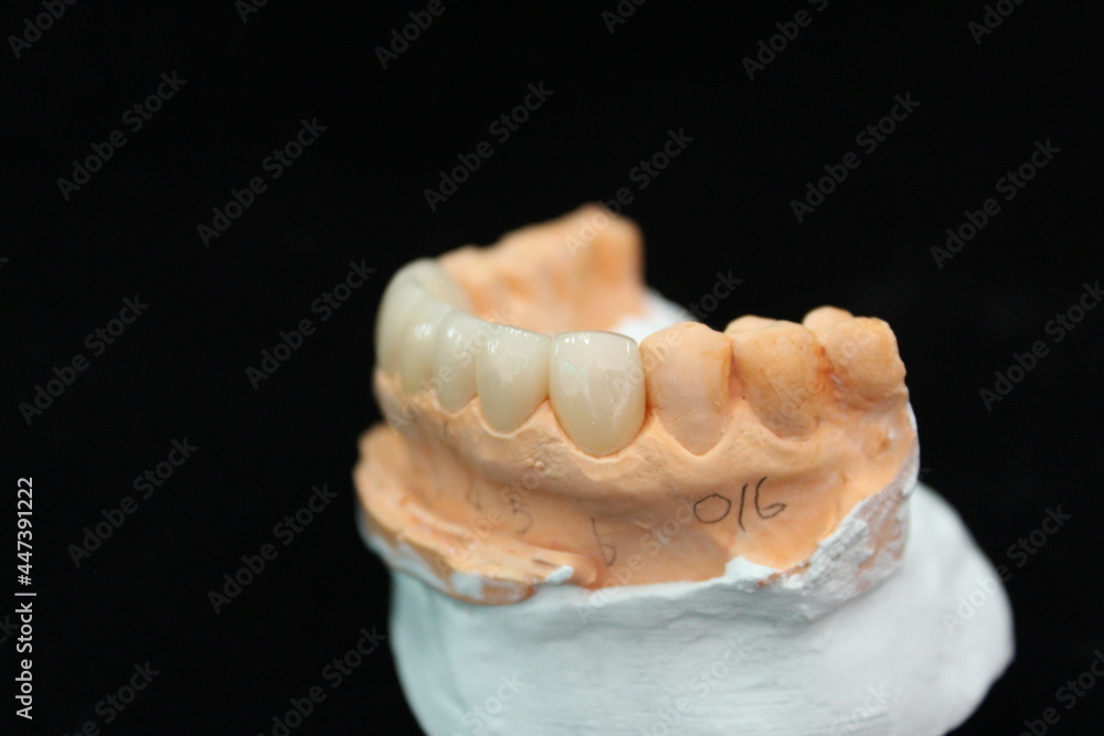 Dental crown and veneer in the plaster model