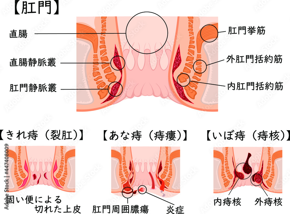 21 BEST 外痔核 IMAGES, STOCK PHOTOS u0026 VECTORS  Adobe Stock