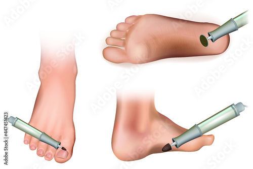 Apparatus for hardware pedicure. Cutters and Accessories and nail tool on white background.Cutter for a hardware pedicure to clean the feet from calluses