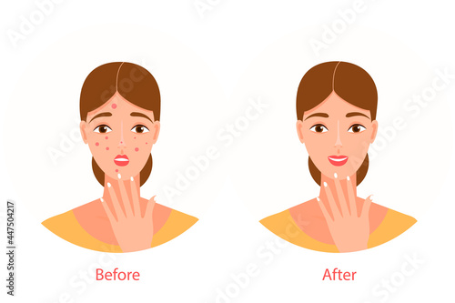 A young beautiful woman with red pimples on her face. Before and after illustration, in a flat cartoon style. The girl is upset, happy. Acne treatment. Vector isolated on a white background