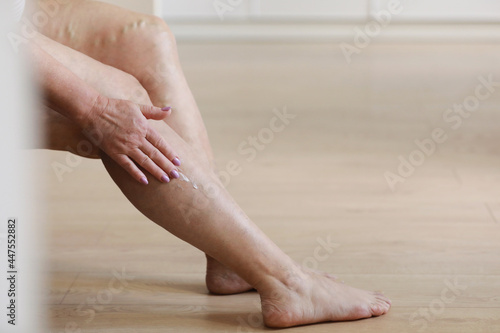Painful varicose and spider veins on active womans legs, self-helping herself in overcoming the pain. Vascular disease, varicose veins problems, active life concept. photo