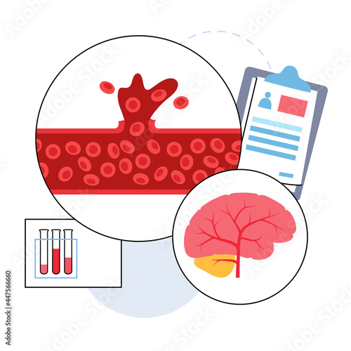 Brain stroke hemorrhagic