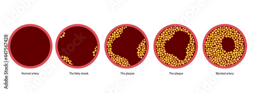 Cholesterol and atherosclerosis