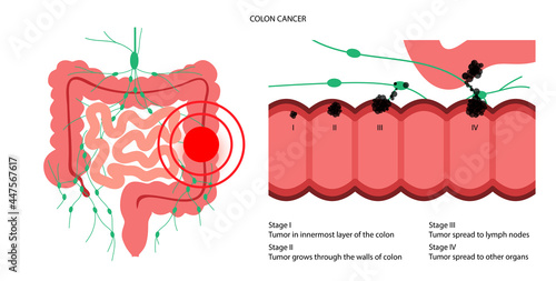 Colon cancer stage