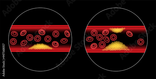 Cholesterol and atherosclerosis