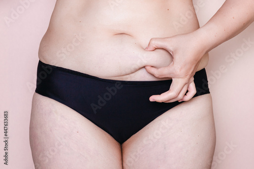 woman holding her belly with stretch marks pink background
