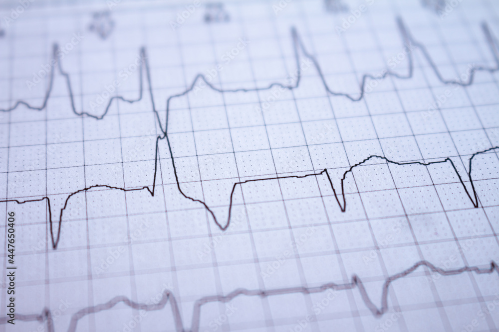 Close-up of heartbeats recorded on the paper of the electrocardiogram. Selective focus. Approach to a cardiac arrhythmia.