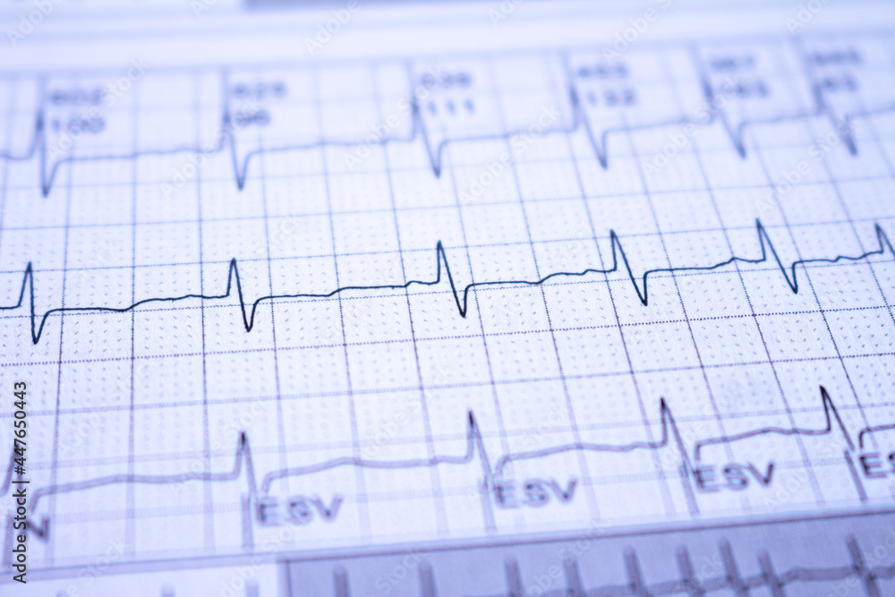Close-up of heartbeats recorded on the paper of the electrocardiogram. Selective focus. Approach to a cardiac arrhythmia. Close-up of heartbeats recorded on the paper of the electrocardiogram. Selective focus. Approach to a cardiac arrhythmia.