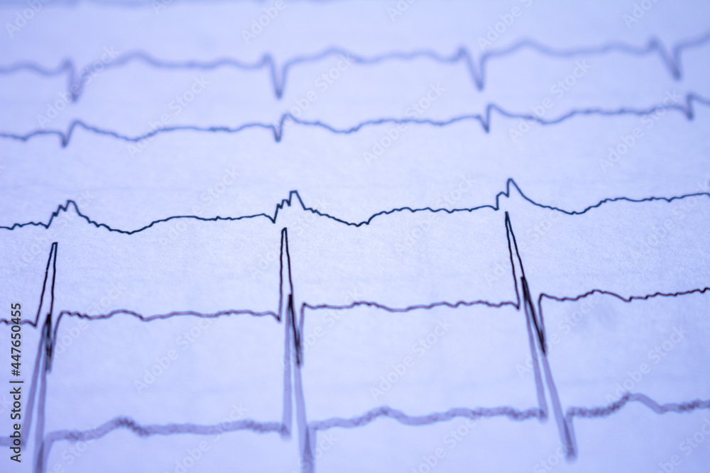 Close-up of heartbeats recorded on the paper of the electrocardiogram. Selective focus. Approach to a cardiac arrhythmia.