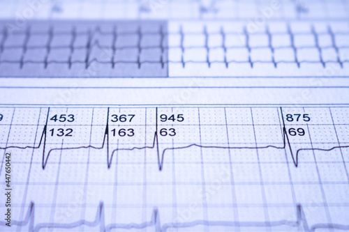 Close-up of heartbeats recorded on the paper of the electrocardiogram. Selective focus. Approach to a cardiac arrhythmia.