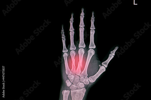 Hand xray showing fractured third and forth metacarpal bones. photo