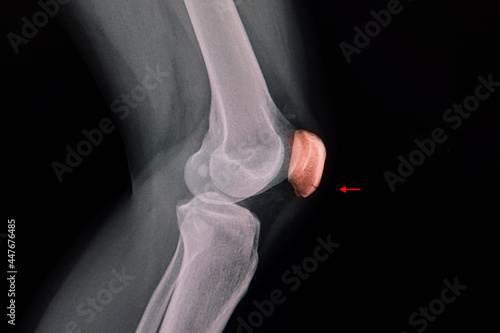 Knee xray of a patient showing a lucent line at lower part of patella photo