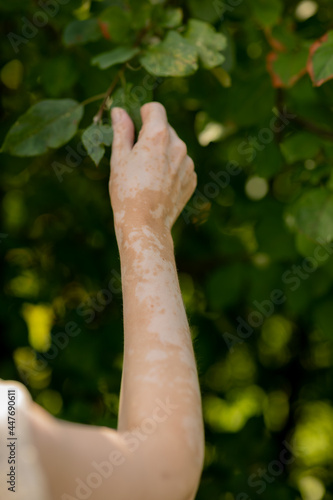 Hand skin pigmentation. White-brown leather. Melasma. Benign pigmentation. Hormonal Disorders. Medical concept.