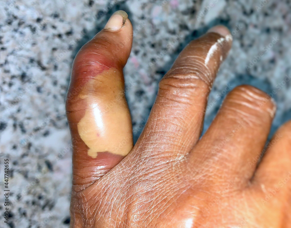 abscess with surrounding cellulitis or Staphylococcal / Streptococcal