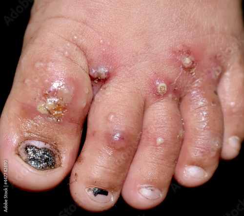 Scabies Infestation with secondary or superimposed bacterial infection and pustules in foot of Southeast Asian, Burmese child. A contagious skin condition caused by mites. photo