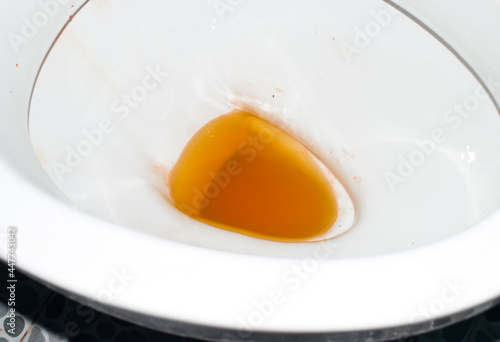 High coloured urine in toilet. photo