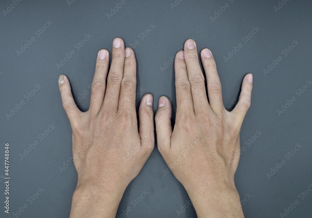 Bilateral little finger deviation in Asian young man. Bilateral hand deformities. Abnormal fingers extension. - obrazy, fototapety, plakaty 