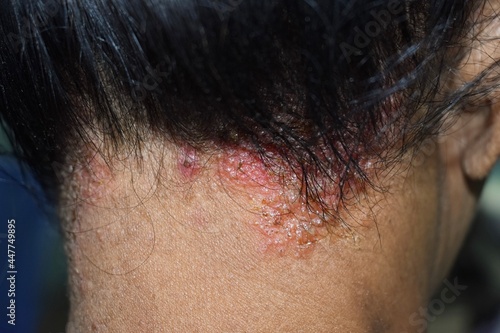 Seborrheic dermatitis or fungal skin infection at the scalp of Southeast Asian, Myanmar adult female patient. photo