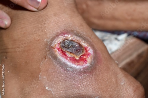 Chronic ulcer or wound on the dorsum of foot in Southeast Asian, burmese, adult male patient. photo