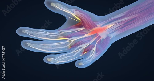 Carpal tunnel syndrome, carpal tunnel syndrome, median nerve entrapment and inflammation, hand anatomy, neurons, body tissues, 3D illustration photo