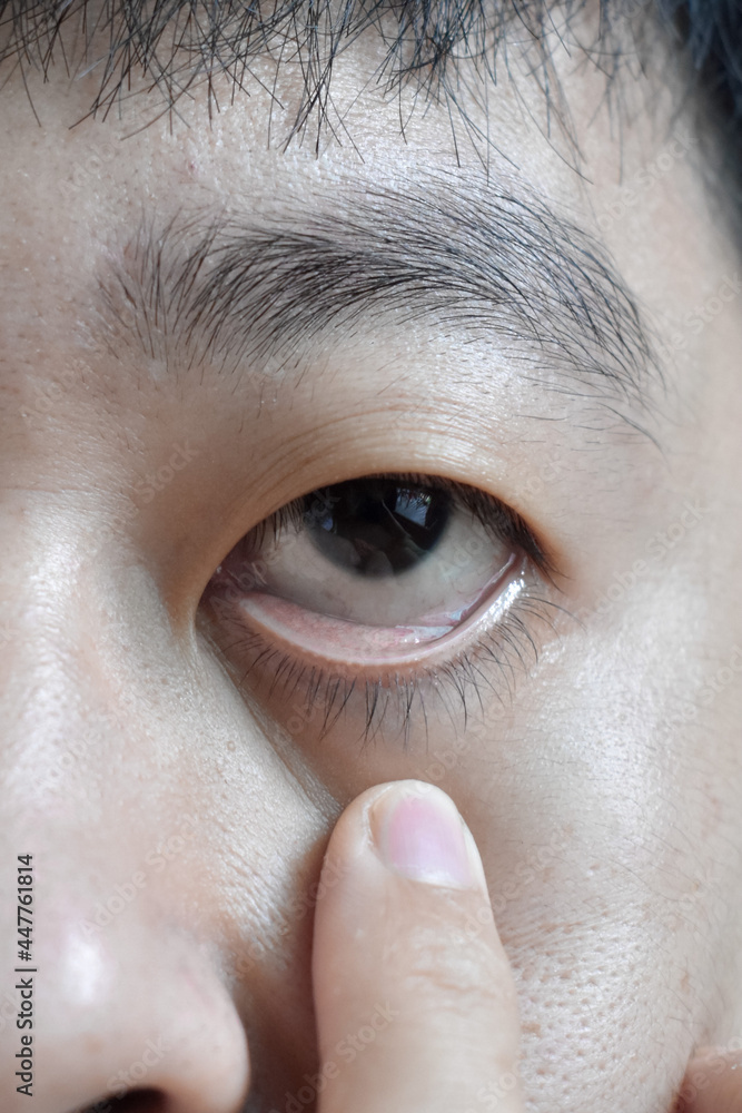 Pale skin of Asian man. Sign of anemia. Pallor at eyelid. Stock Photo