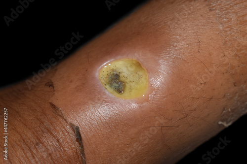 Photos Diabetic ulcer in leg of Asian. patient. Poor wound healing.
