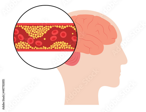 Brain stroke ishemic