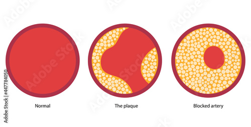 Cholesterol and atherosclerosis