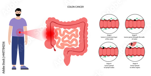 Colon cancer stage
