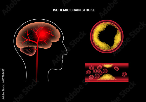 Brain stroke ishemic