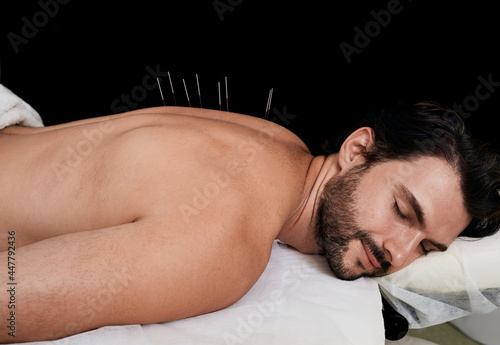 Patient receiving body acupuncture procedure lying down in China medical clinic. Man with acupuncture needles in his spine, isolated on black background