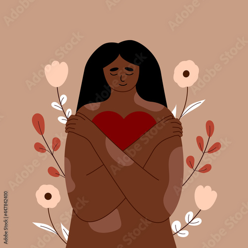 Young woman with psoriasis skin disease, girl with vitiligo hugs herself and her body. He holds a heart in his hands. Love yourself, self confidence and care. Accept yourself, body positive. Vector
